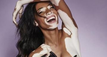 Winnie Harlow Tatilde!