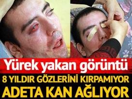 8 yıldır gözlerini kırpamıyor, adeta kan ağlıyor